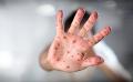             First Monkeypox deaths reported outside Africa
      
